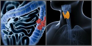 Gut Infection Linked to Hypothyroid