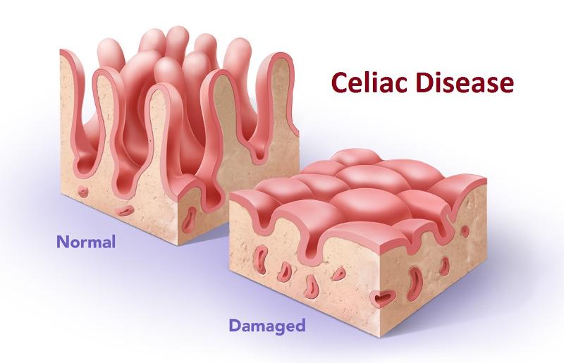 Dr. Ruscio's, DC Wrap Up #69 - celiac disease