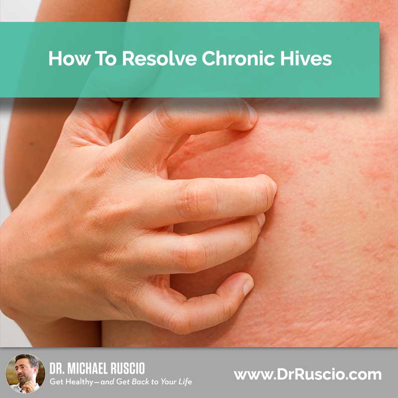 How to Resolve Chronic Hives – Audience Question