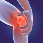 Arthritic Joint