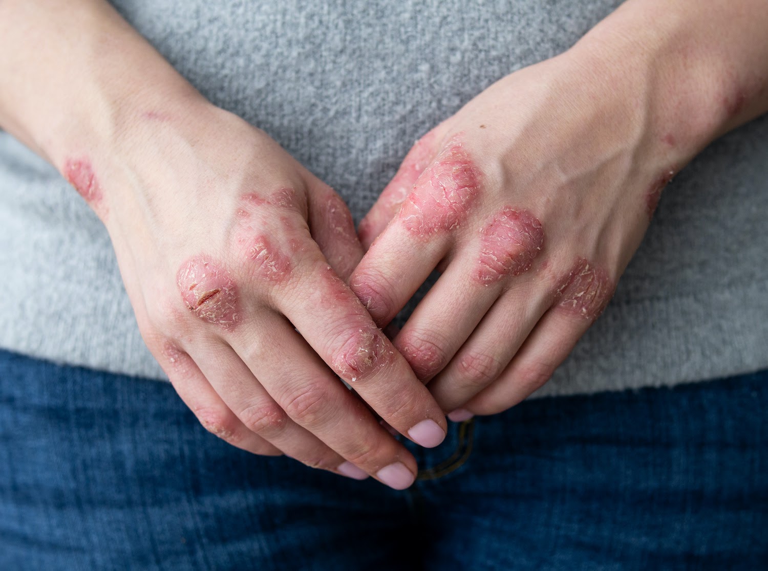 The Surprising Autoimmune Skin Disease Gut Health Connection