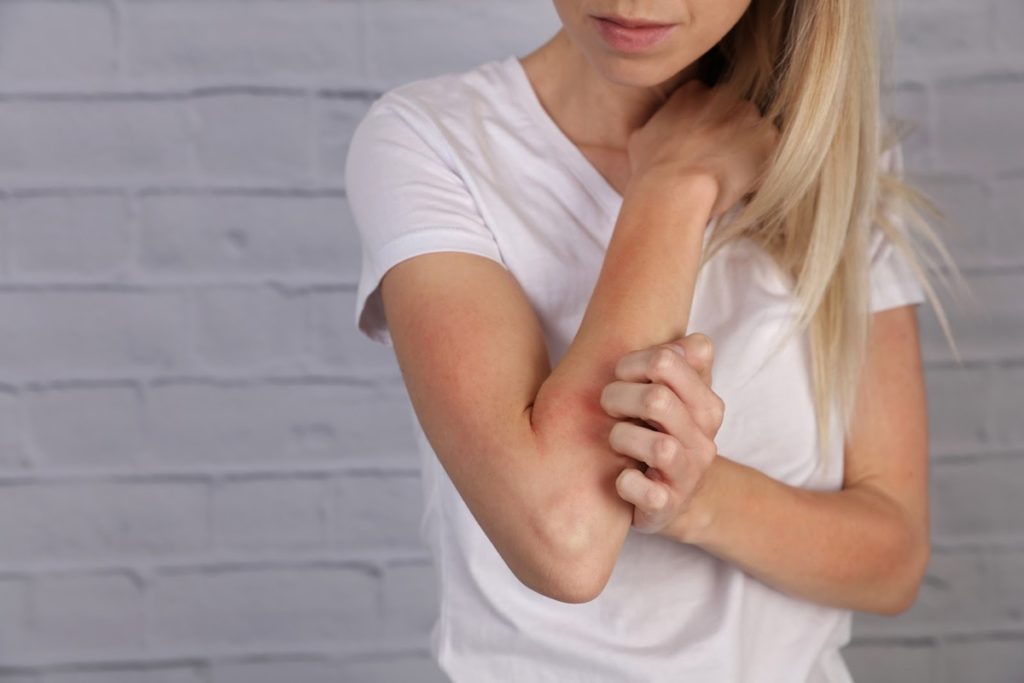 foods that cause eczema: Woman scratching her arm