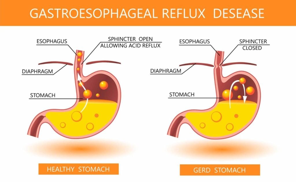 LPR symptoms: Healthy stomach vs. GERD stomach comparison chart