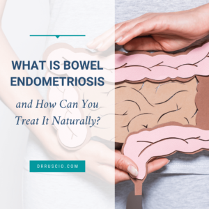 What Is Bowel Endometriosis and How Can You Treat It Naturally?