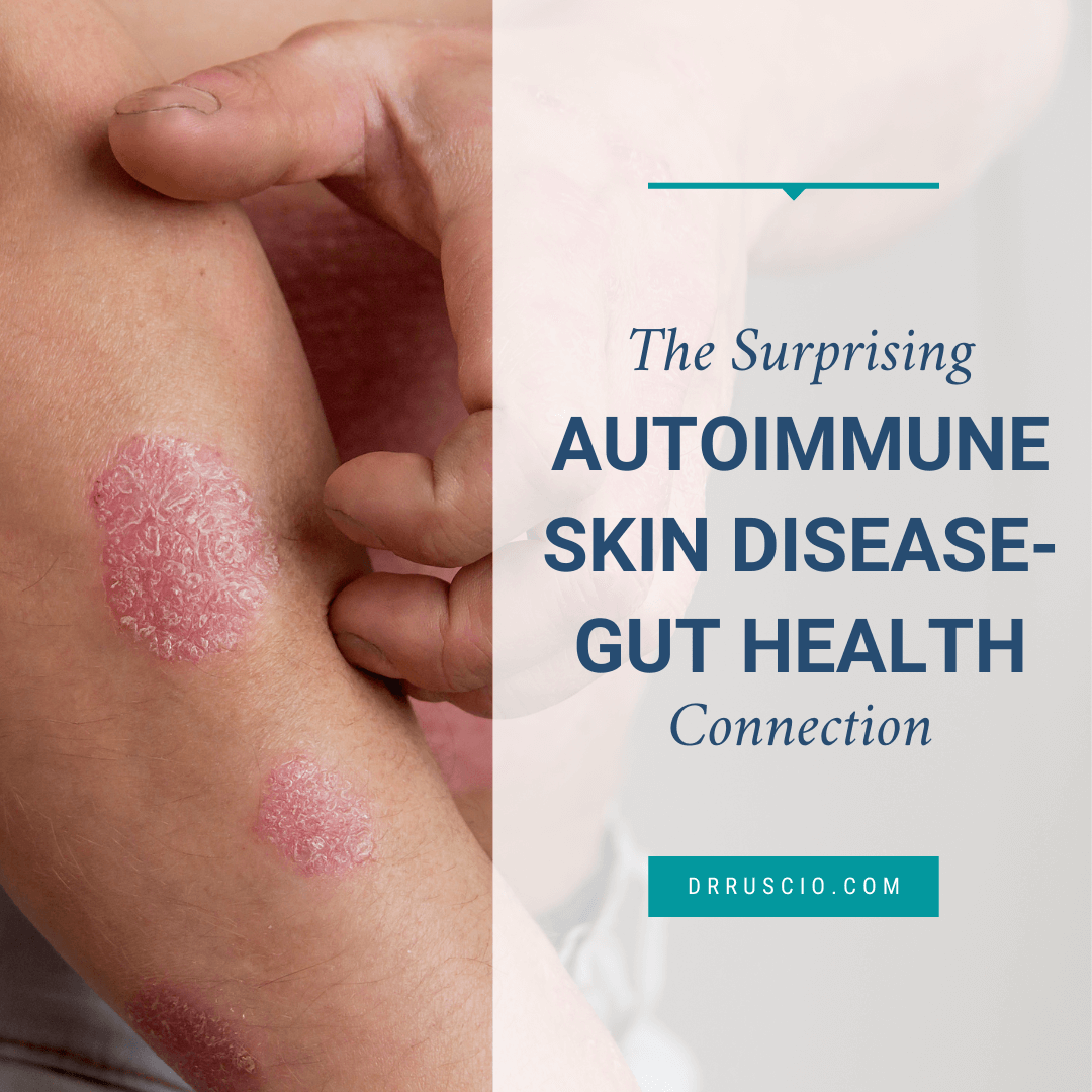 The Surprising Autoimmune Skin Disease-Gut Health Connection