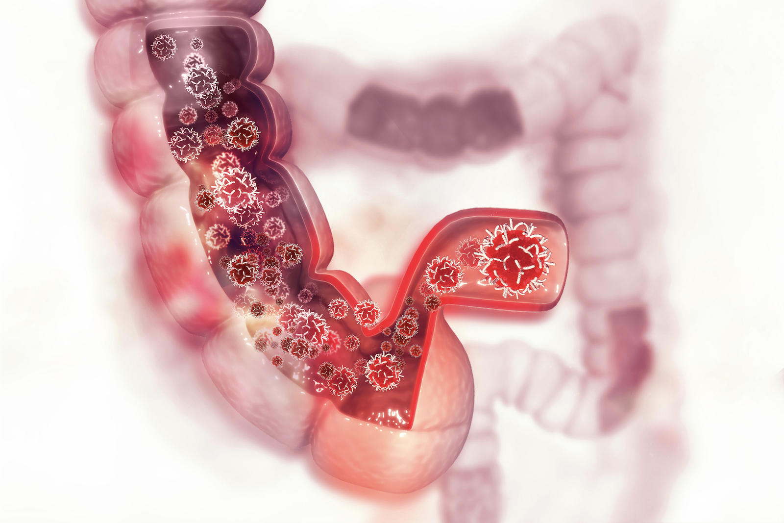 colon pain: 3D illustration of cancer cells inside the colon