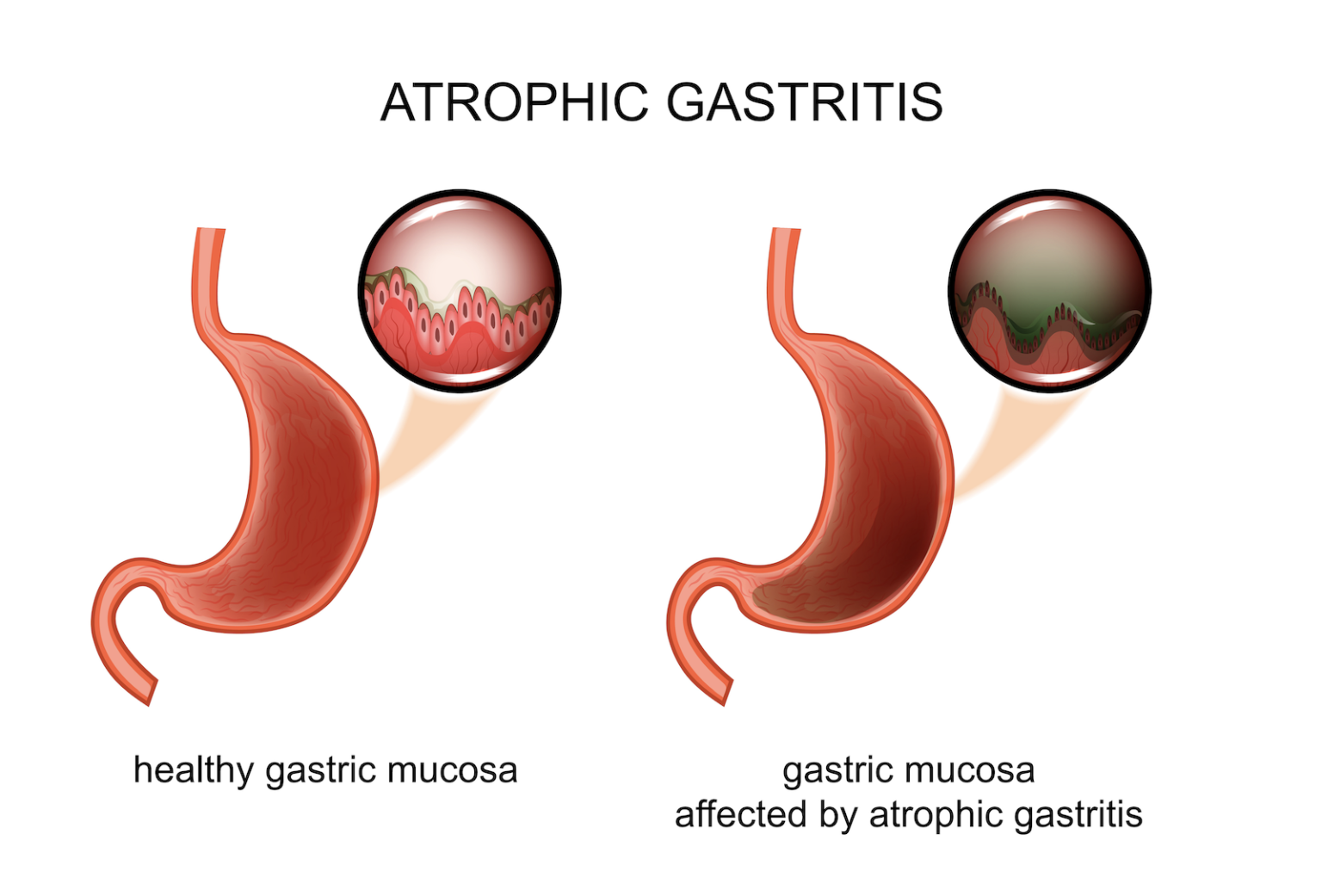 Tratamiento gastritis cronica atrofica